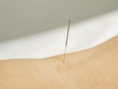 Gros plan sur une aiguille d'acupuncture.